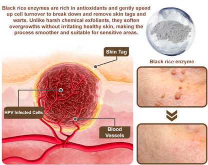 Zvoevo® Black Rice Skin Repair Essence Cream ⚕️ FDA Certified (Removes warts and skin growths, improves keratin buildup and seborrheic dermatitis, follicular keratosis, age spots, and bruising)