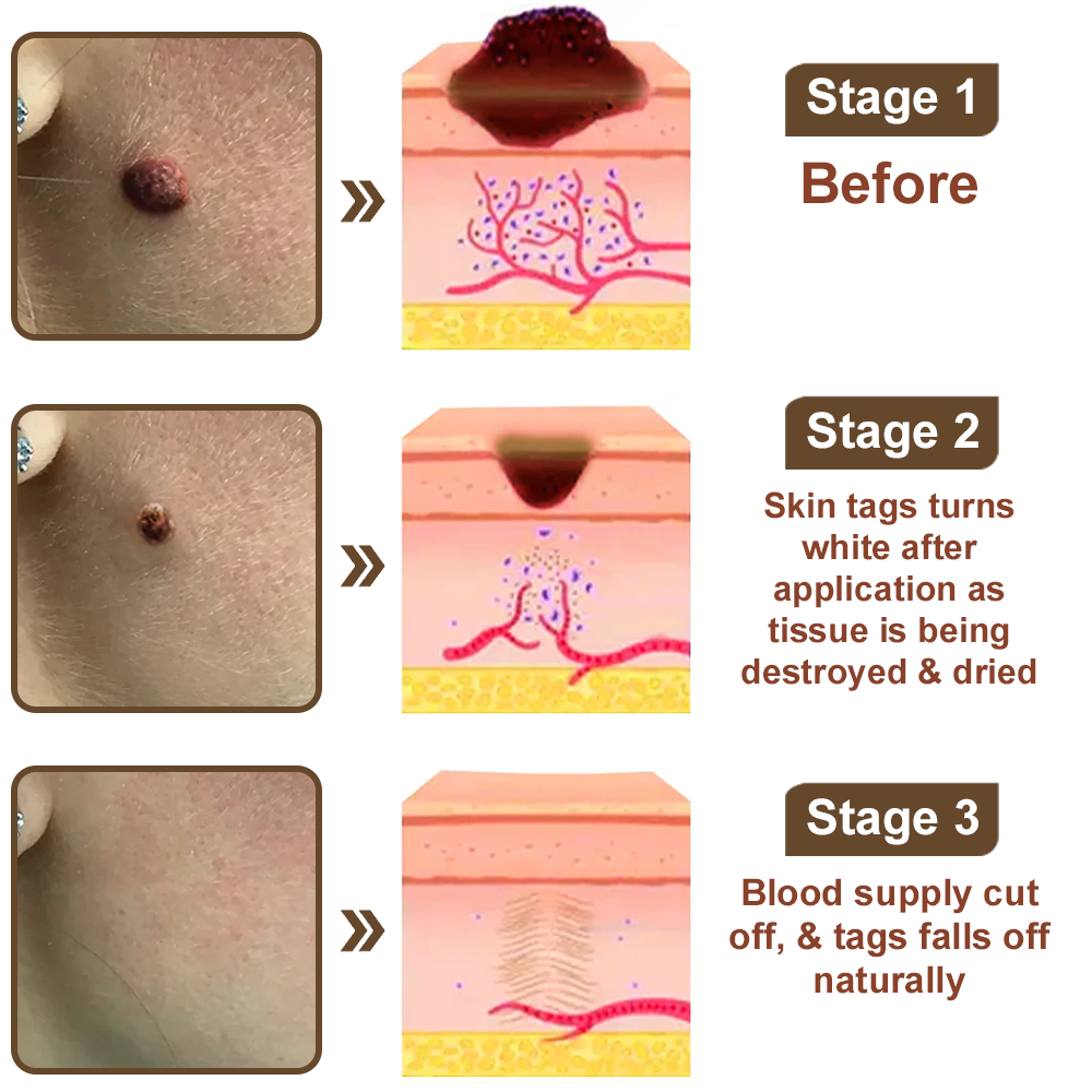 Zvoevo® Black Rice Skin Repair Essence Cream ⚕️ FDA Certified (Removes warts and skin growths, improves keratin buildup and seborrheic dermatitis, follicular keratosis, age spots, and bruising)