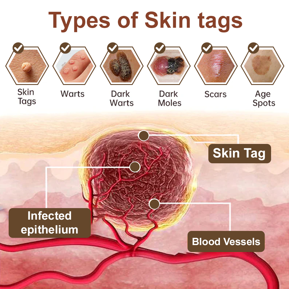 Zvoevo® Black Rice Skin Repair Essence Cream ⚕️ FDA Certified (Removes warts and skin growths, improves keratin buildup and seborrheic dermatitis, follicular keratosis, age spots, and bruising)