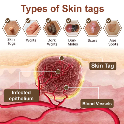 Zvoevo® Black Rice Skin Repair Essence Cream ⚕️ FDA Certified (Removes warts and skin growths, improves keratin buildup and seborrheic dermatitis, follicular keratosis, age spots, and bruising)